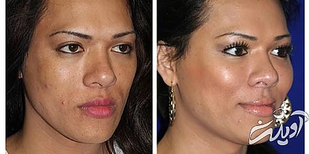 پروتز گونه, پروتز گونه چیست, انواع پروتز گونه